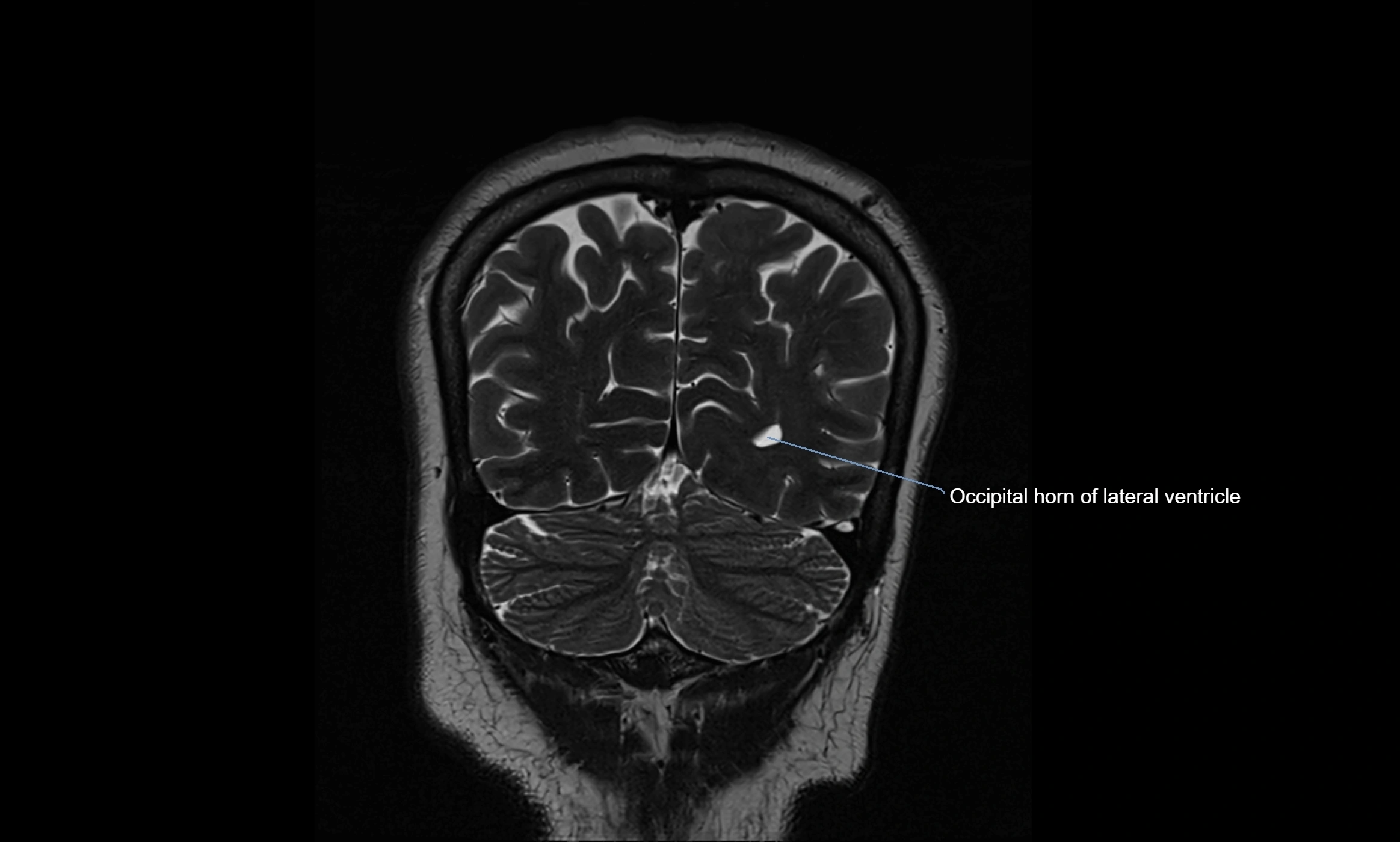 Brain cisterns  and ventricles coronal anatomy 3T MRI image-img-00001-00051.webp